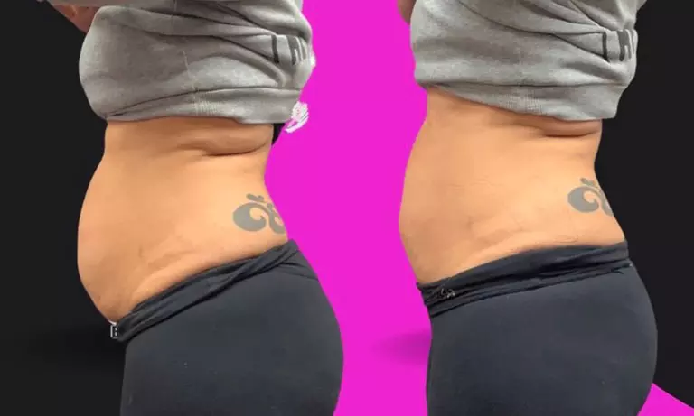 Explore Cavitation with Tailored Package Sessions