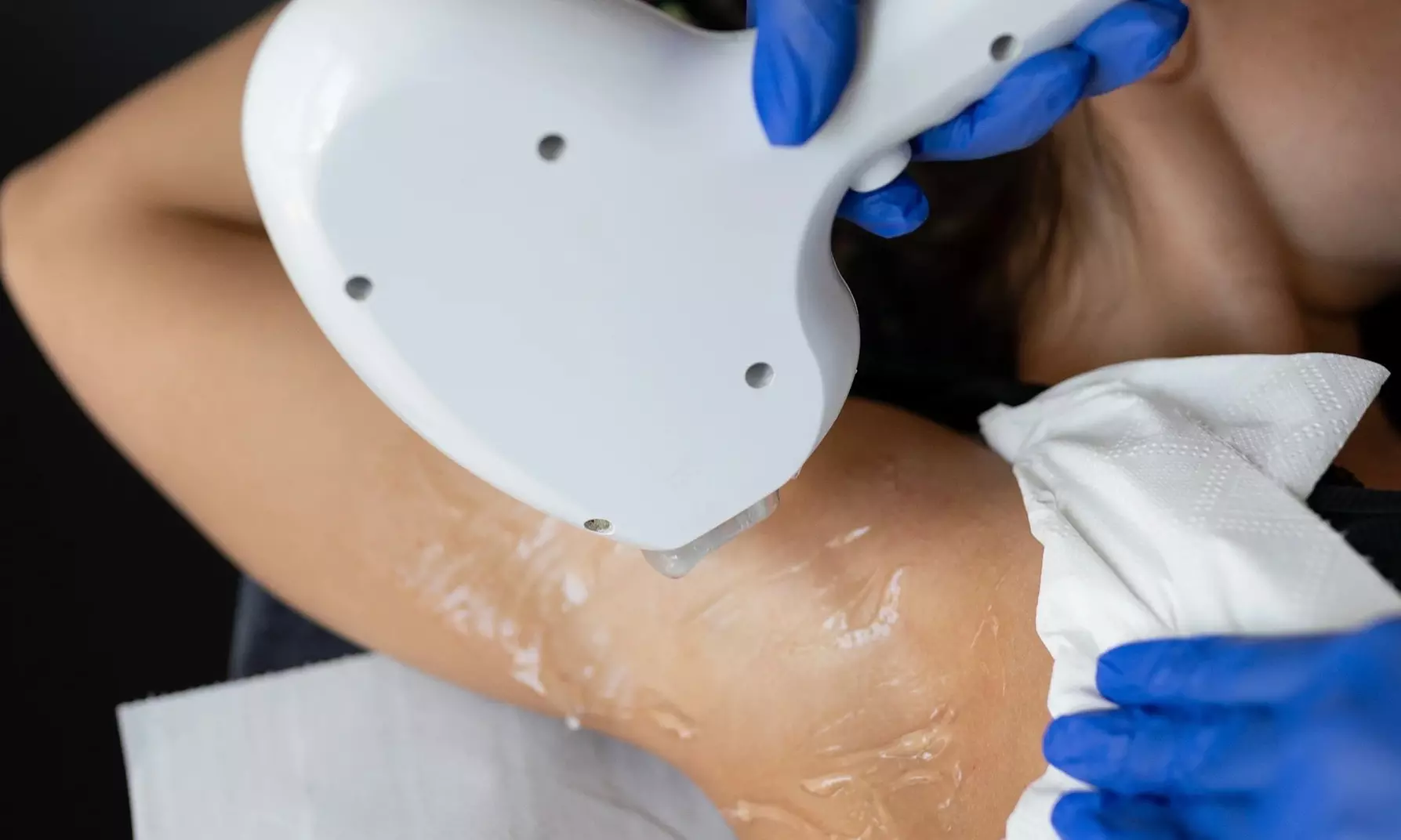 Zabiegi depilacji laserowej na wybrane partie ciała