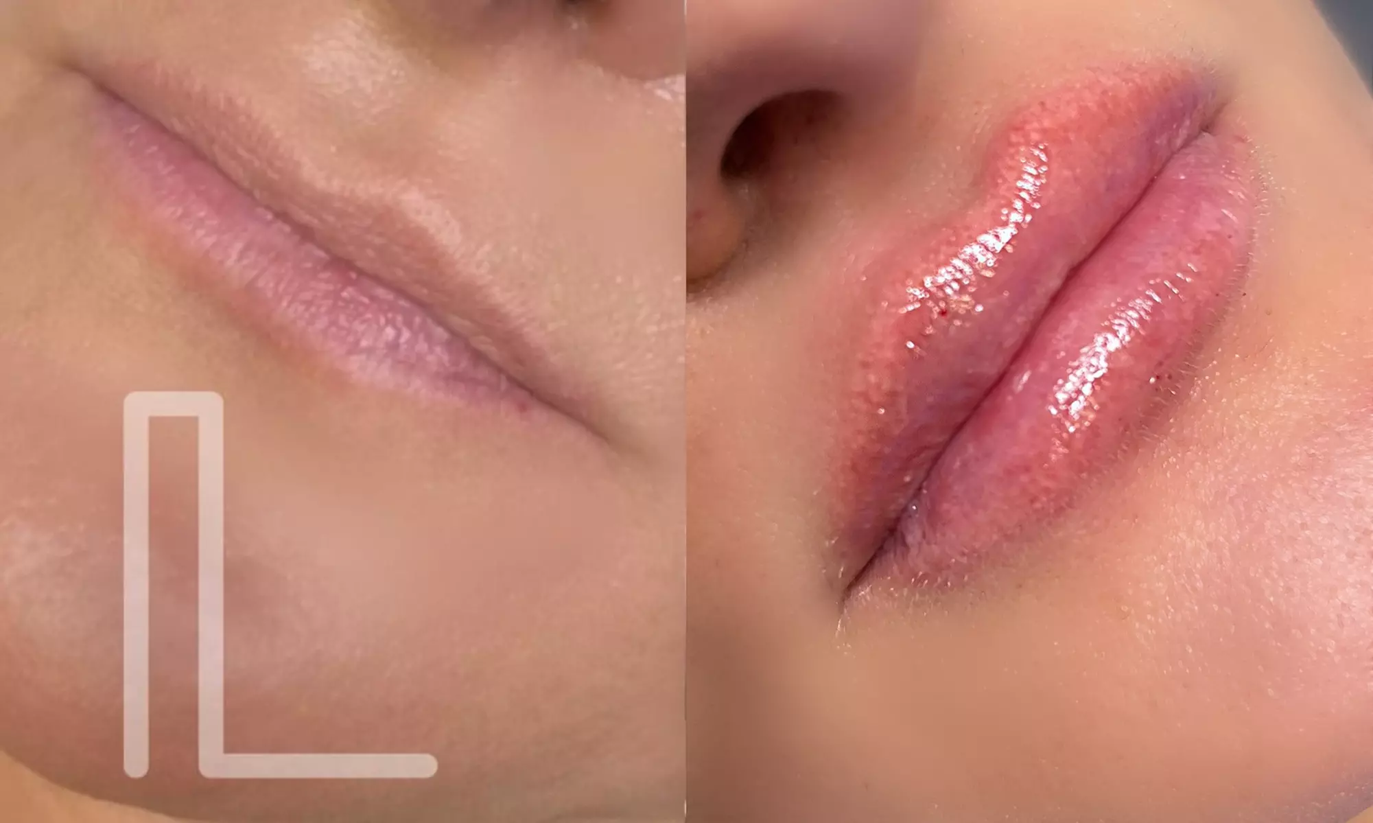 Up to 52% Off on Lip Enhancement at Lux Beauty by Zora - Primary Image