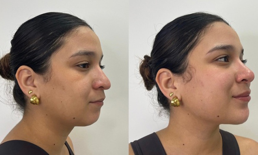 Image 3: Infiltración de toxina efecto lifting facial con opciones extra para 1