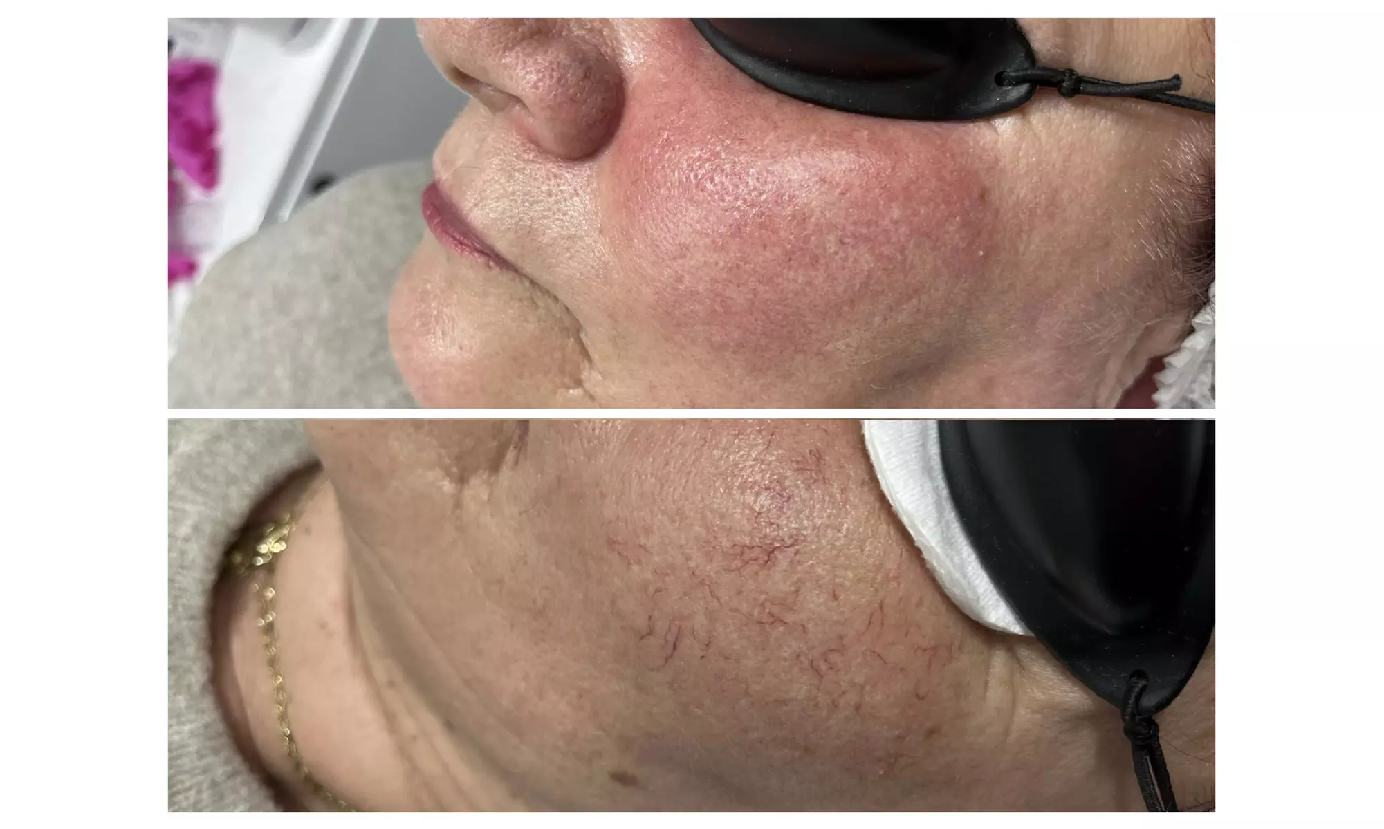 Laserowe zamykanie naczynek i usunięcie włókniaków na twarzy, nogach i innych obszarach ciała (do -40%) - Second Medium