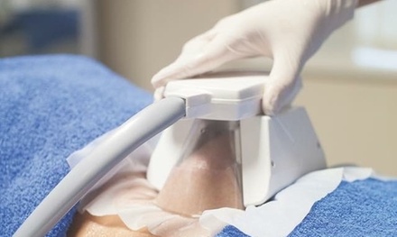 One cup: cryogenic lipolysis