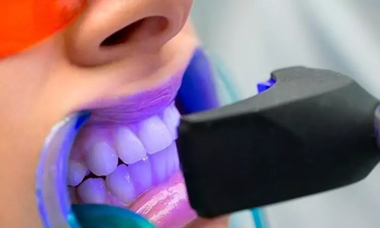 Brighten Your Smile in Just 30 Minutes with Teeth Whitening