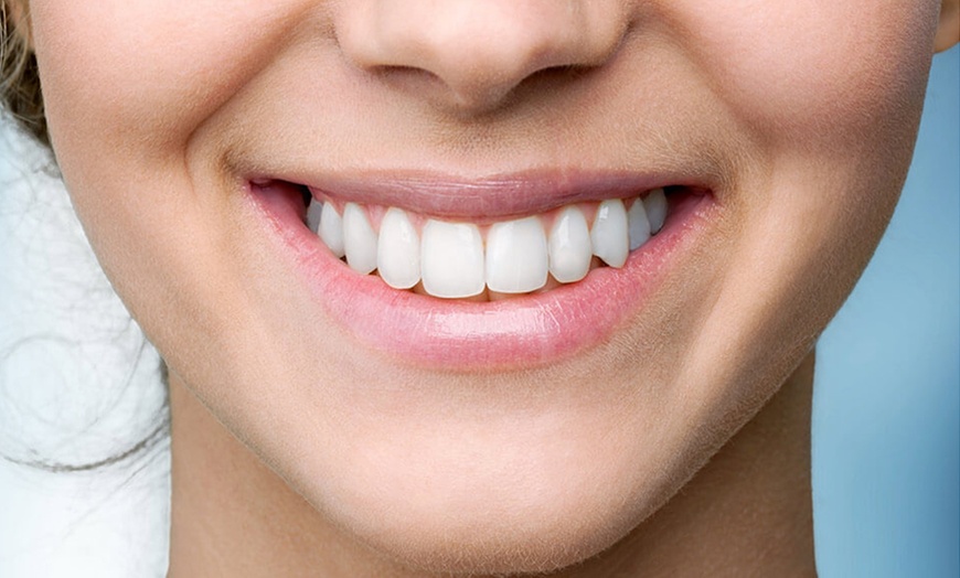 Image 1: One or Two Teeth Whitening Sessions at Glow Enhancements