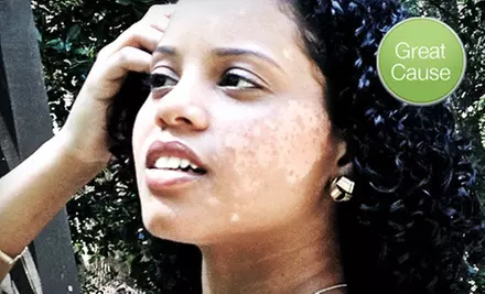 If 50 People Donate $10, Then Vitiligo Bond, Inc. Can Distribute Summer Sun-Protection Kits to Three Youth with Vitiligo - Primary Image