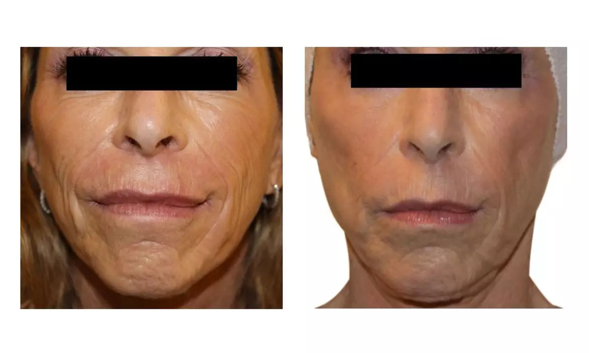 Up to 50% Off on Radio Frequency Skin Tightening at Aqua Stone Spa - Second Medium