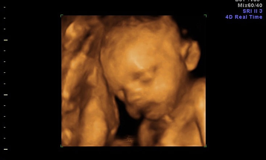 Image 8: 3D/ 4D Baby Scan