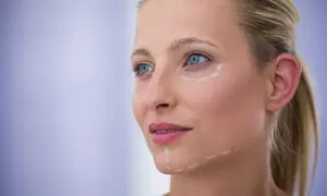 Wertgutschein über bis zu 219€ für ein Vampir-Lifting an einer Zone in der SB clinic