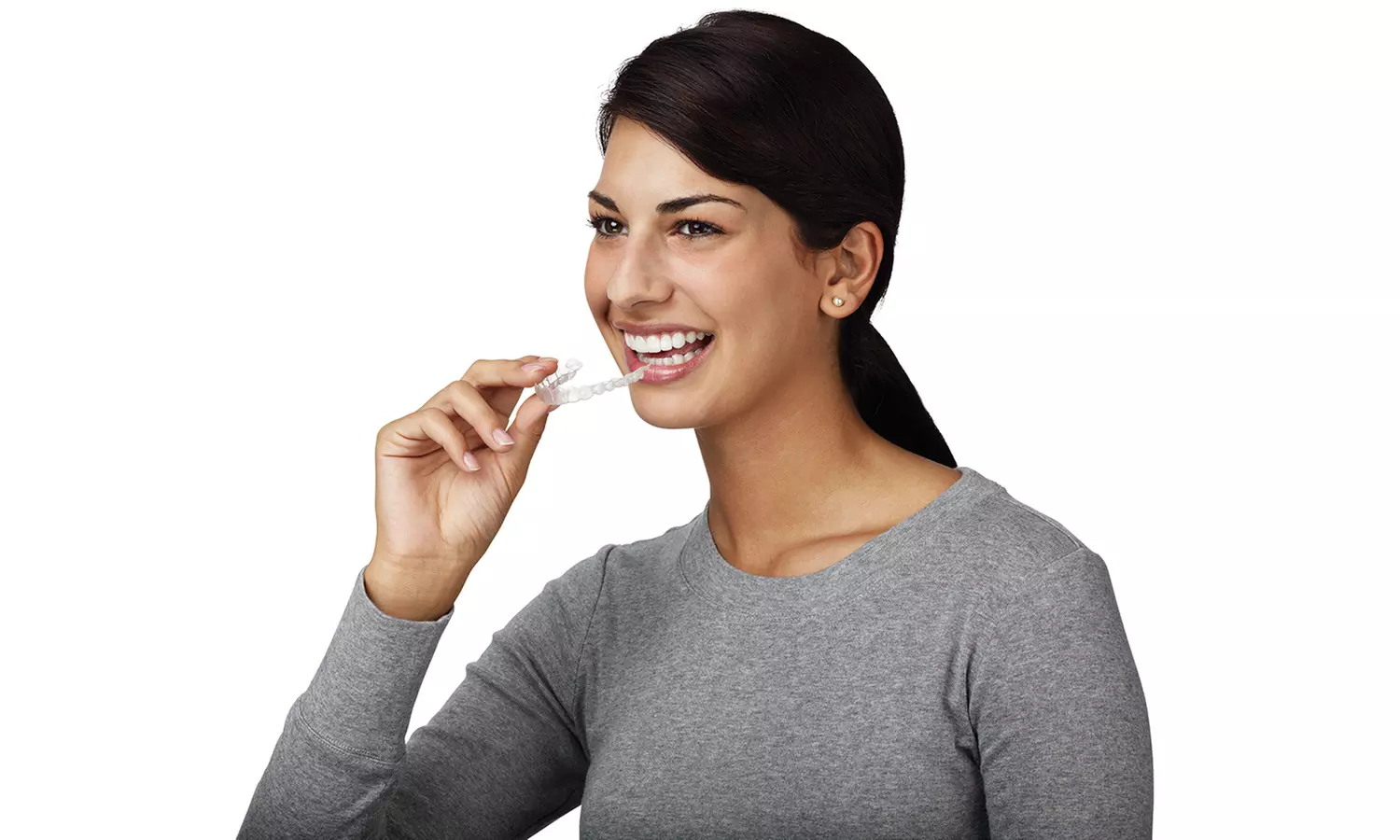$41 for an Invisalign Package at Luv Braces ($1,888 Value) - Primary Image