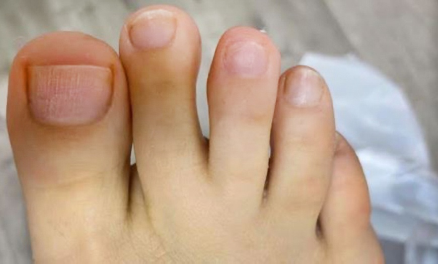 Image 2: Laser Toe Fungus Treatment