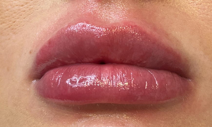 Image 6: 0.5ml Lip Dermal Filler