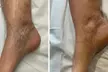 Consult, Ultrasound, Sclerotherapy Spider Vein Removal Injection (10cc) for a 2x2 Area (45-Min) (Up to 55% Off) - Second Medium