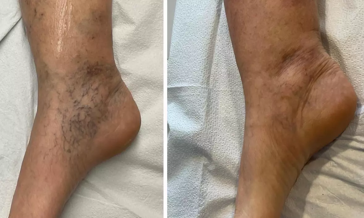 Consult, Ultrasound, Vein Removal Injection (10cc) for a 2x2 Area
