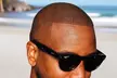 Get A Natural Look At Icy Cold Cutz SMP Using Scalp Micro Pigmentation, at 50% Off - Second Medium