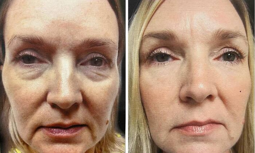 Image 2: Enhance and Transform your Skin with Bellafill Injection and Rejuvenating Micropeel and Save Up To 33%