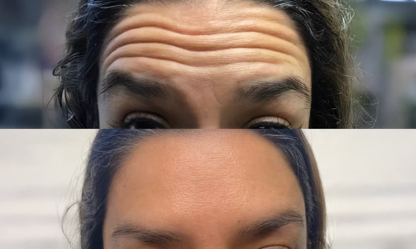 Achieve Youthful Glow with 20 Units of Botox Treatment
