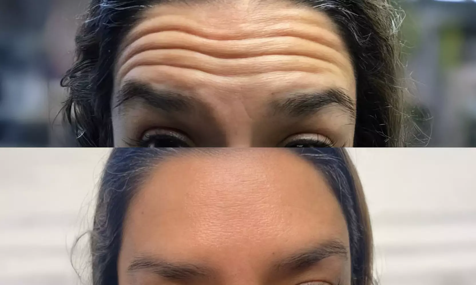 Achieve Youthful Glow with 20 Units of Botox Treatment