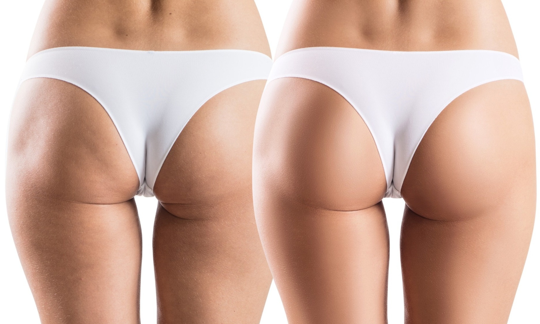 Transform Your Booty with Non-Surgical Butt-Lift Sessions