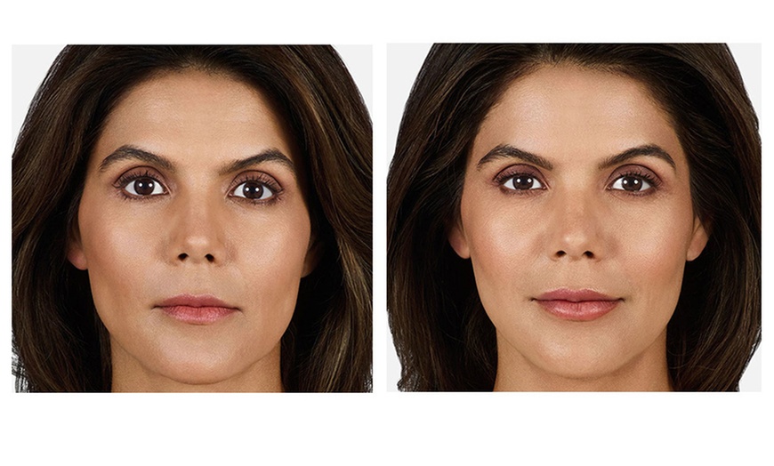 Image 3: Enhance with 20, 40 Units of Botox or Lip Flip (Up to 10 Units)