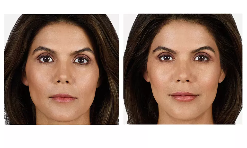 Enhance with 20, 40 Units of Botox or Lip Flip (Up to 10 Units)
