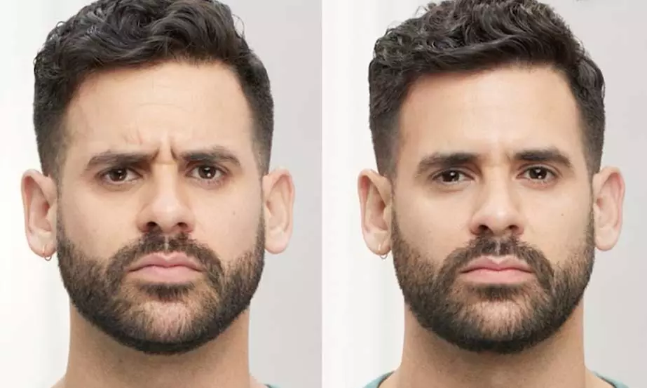 Get a Fresh Look Fast with 20, 40, or 60 Units of Botox