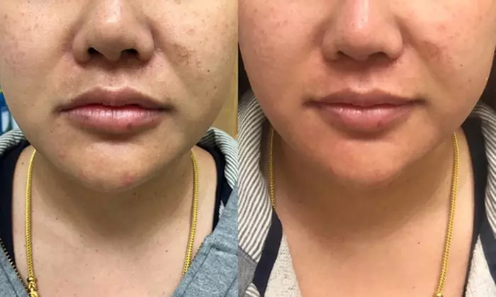 Microdermabrasion with LED Light for Radiant Skin