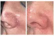 1 or 2 Spider Vein/Cluster Removal Treatment with Consultation/ Dark Spot Treatment Small Area (Up to 45% Off) - Second Medium