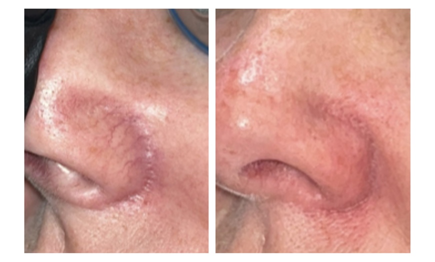 Image 6: One or Two Spider Vein/Cluster Removal Treatment with Consultation