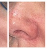 Image 5: One or Two Spider Vein/Cluster Removal Treatment with Consultation