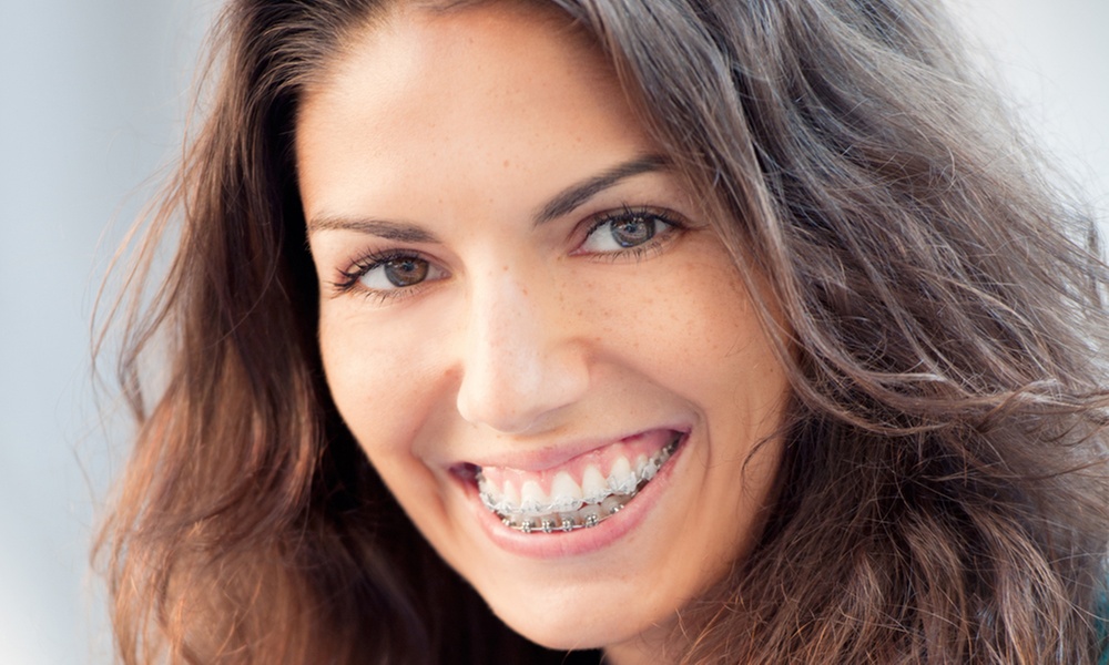 Up to 71% Off on Braces Upper & Lower, Fixed Retainers & Whitening at iDental