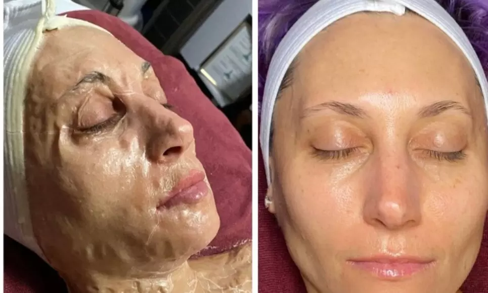 Peel Away the Past – Your Fresh Face Starts Here at The Skin Sanctuary