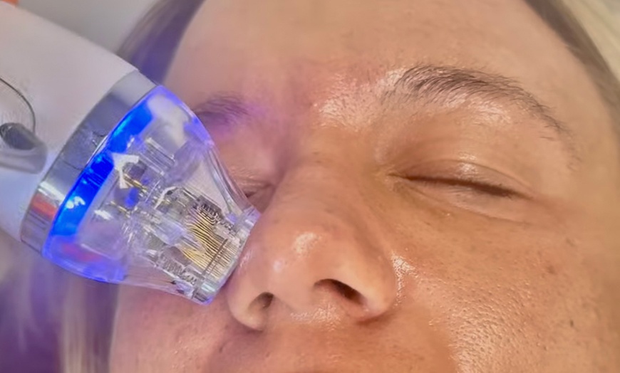 Image 3: Radiant Skin with Expert Microneedling & PRP Facials in Upper Darby


