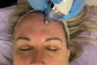 Limpieza facial con opción a IPL y microdermoabrasión para 1, con hasta 80% de descuento - Image 2
