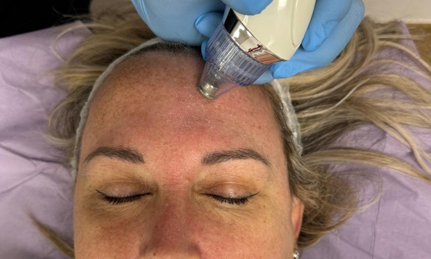 Image 3: Limpieza facial con opción a microdermoabrasión para 1 persona