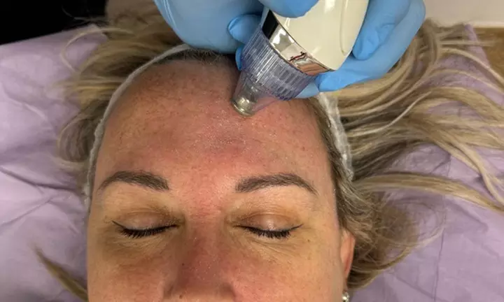 Limpieza facial con opción a microdermoabrasión para 1 persona