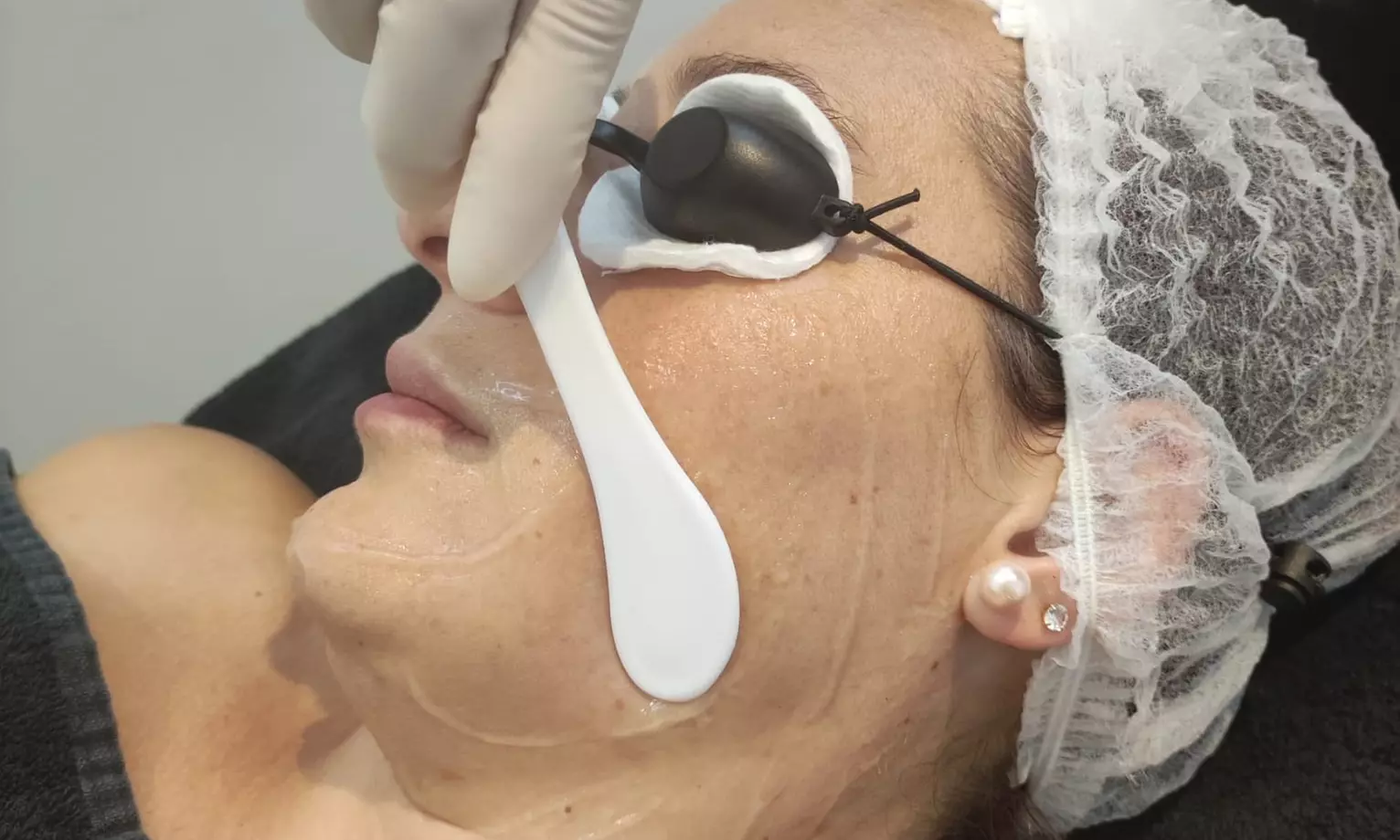 Tratamiento facial con láser en Sapphira Prive Madrid centro