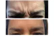 Revitalize Your Look with 20 Units of Botox at Sona MedSpa of Richmond - Glen Allen (Up to 30% Off) - Second Medium