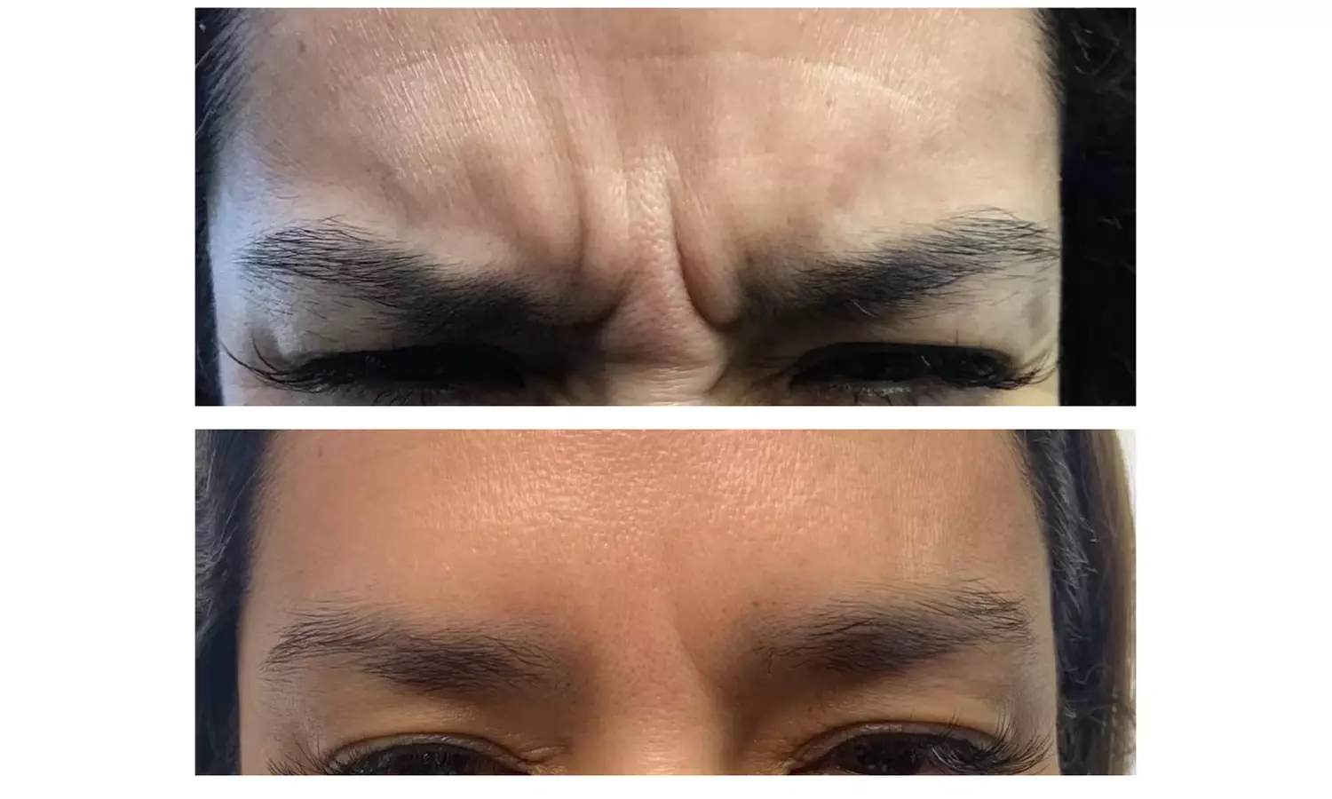 Revitalize Your Look with 20 Units of Botox