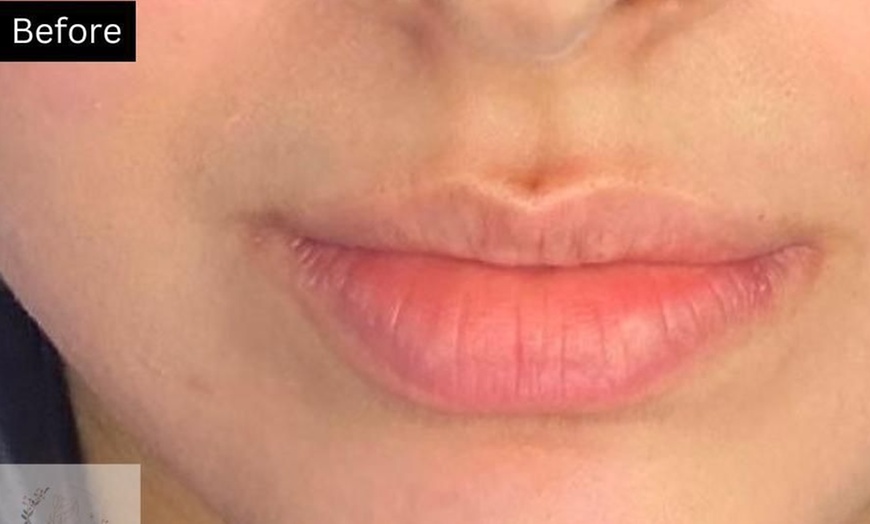 Image 6: 1ml or 2ml Filler for Lips, Russian Lips, Jawline, Chin or Cheek 