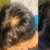 Image 1: Transform with PRP Hair Loss / Face Treatment
