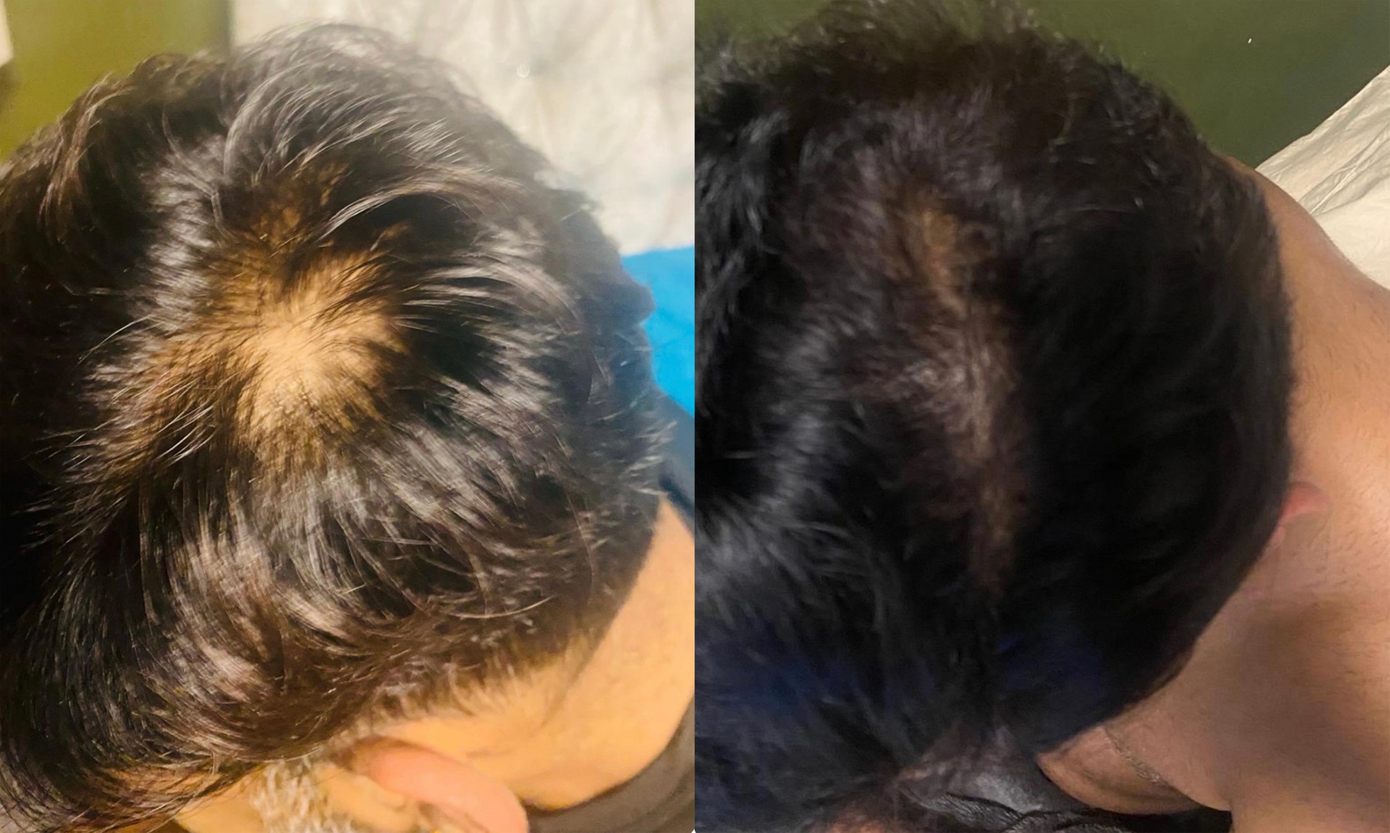 Transform with PRP Hair Loss / Face Treatment