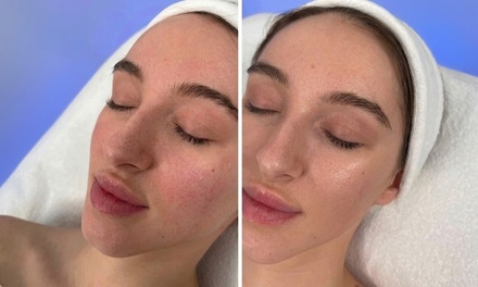 Custom Glow Facial - Diamond  Microdermabrasion, Pro Level Extractions, Oxygen Mask,  Tightening and Lifting CryoTherapy - Chuck Georgies Skincare and Wellness