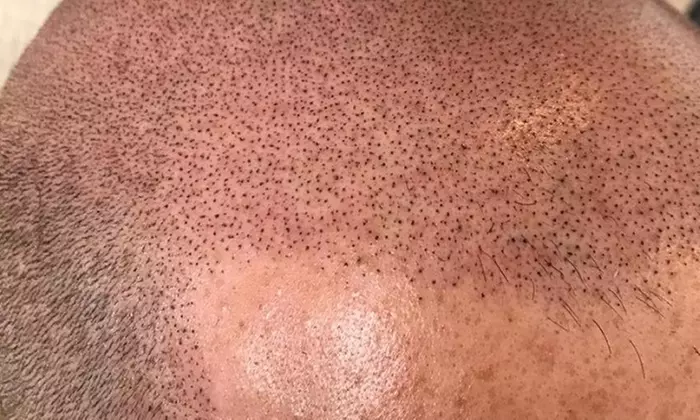 Scalp Micropigmentation
