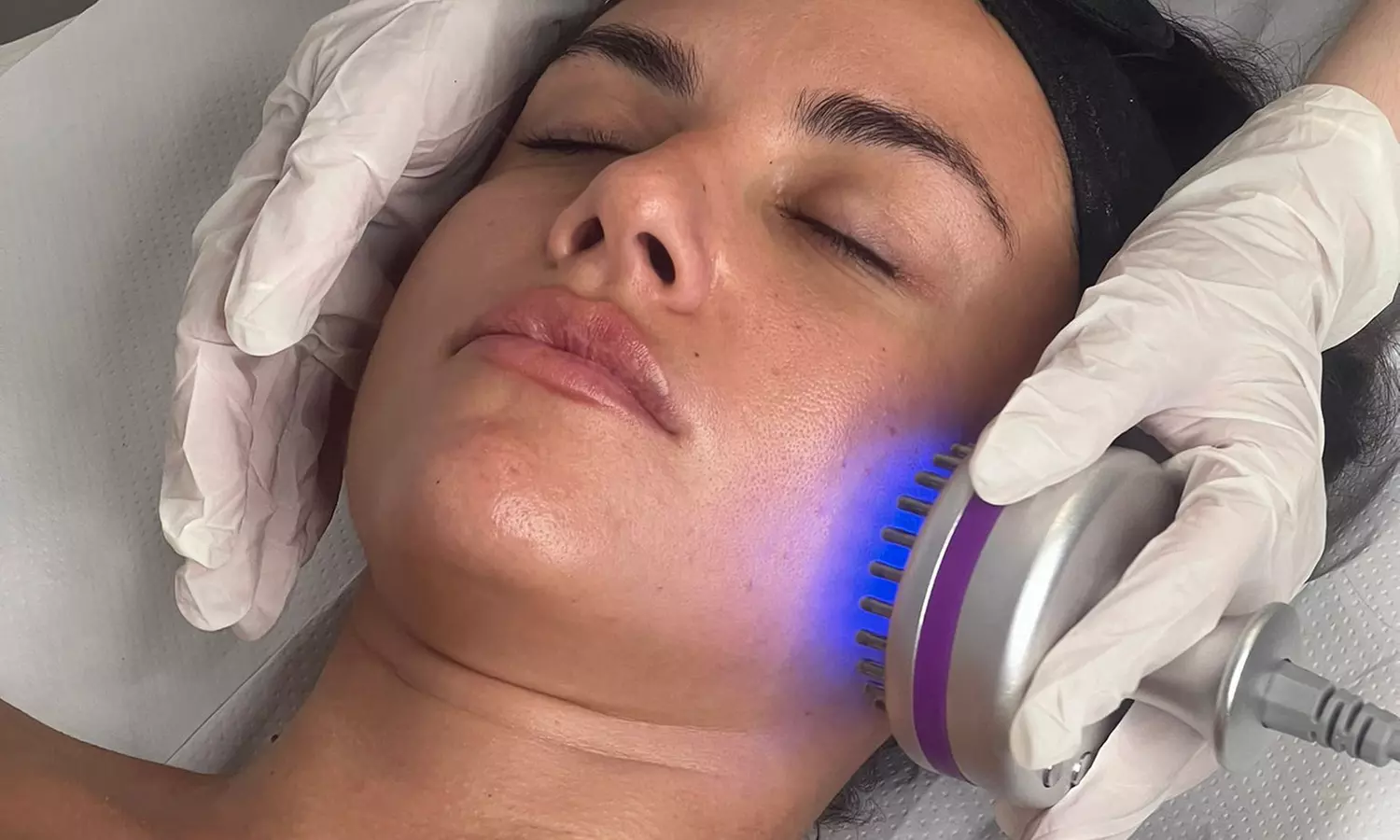 1 o 3 sesiones de eliminación de manchas con láser neodimio yag