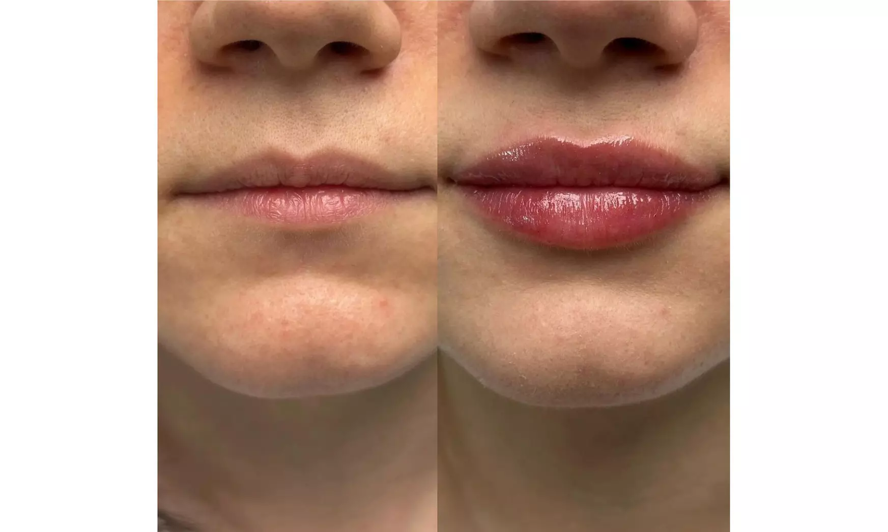 Get the Perfect Pout with 1 or 2 ML Syringe of Versa Lip Filler at The Skincare Studio (Up to 18%Off) - Second Medium