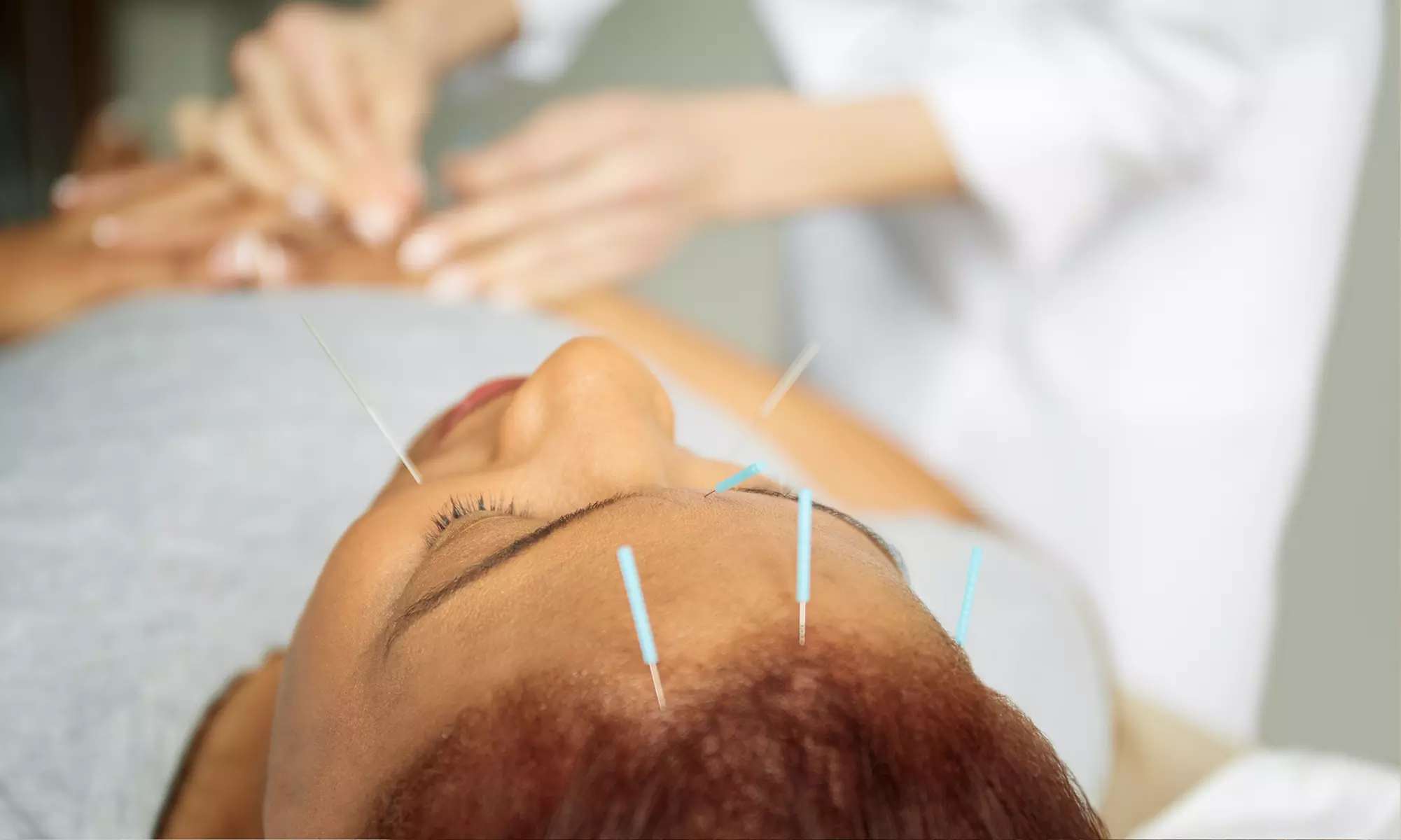 Experience LifeTree Clinic's acupuncture with a consultation and up to 50% off sessions for optimal relief - Primary Image