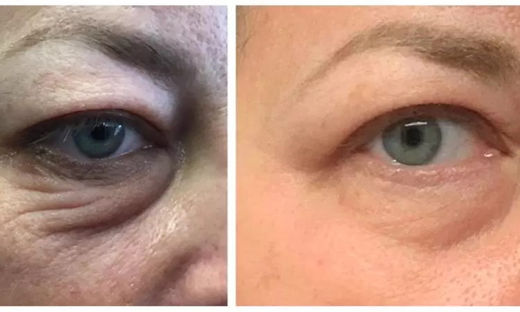 Plasma-Pen Skin-Tightening Session at Body Lab. (Up to 18% Off). Four Options Available. - Primary Image
