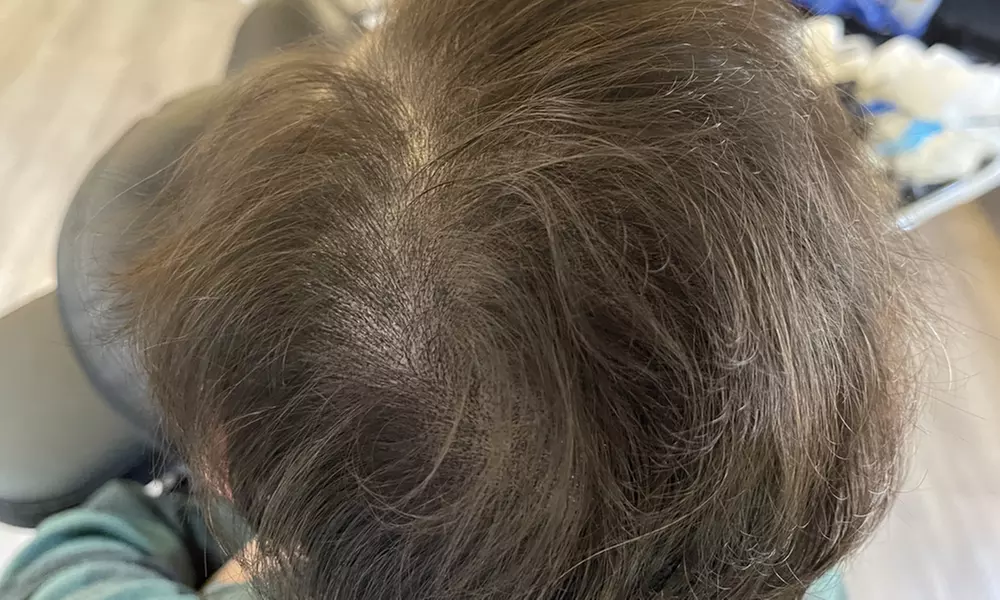 Scalp Micropigmentation Sessions for Various Hair Loss Levels
