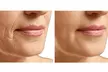 Zen Beauty – Non-Surgical HIFU Facelift & Eye/Mouth Lift: Up to 67% Off - Second Medium