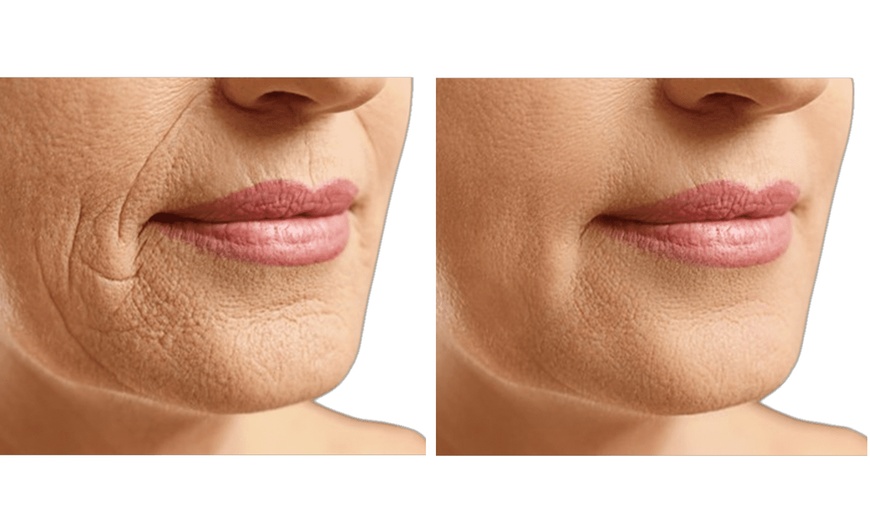 Image 6: Up to 67% Off on Facelift - Non-Surgical at Zen Beauty Ltd